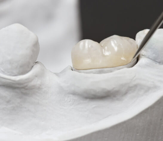 a dental crown on a plaster mold of a mouth