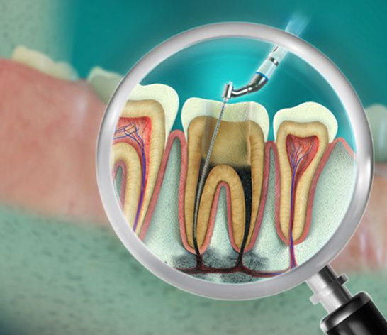 Illustration of instrument being used to clean out dental pulp